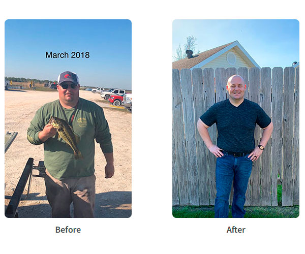 Before and after Sleeve Gastrectomy surgery - Photos by James Parrish, MD