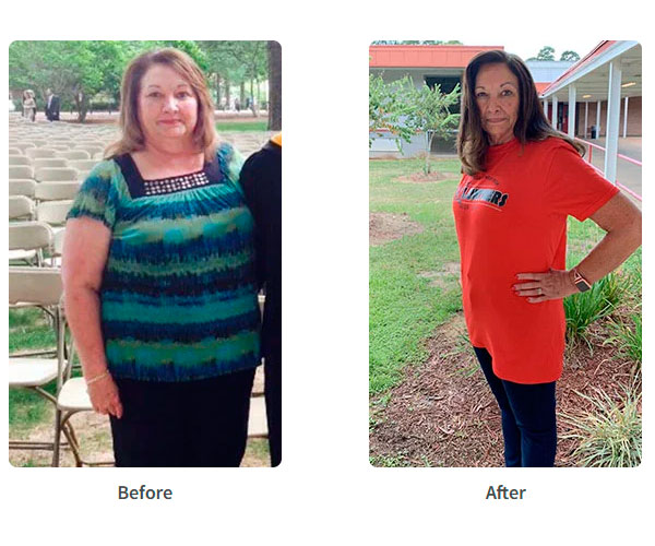 Before and after Sleeve Gastrectomy surgery - Photos by James Parrish, MD