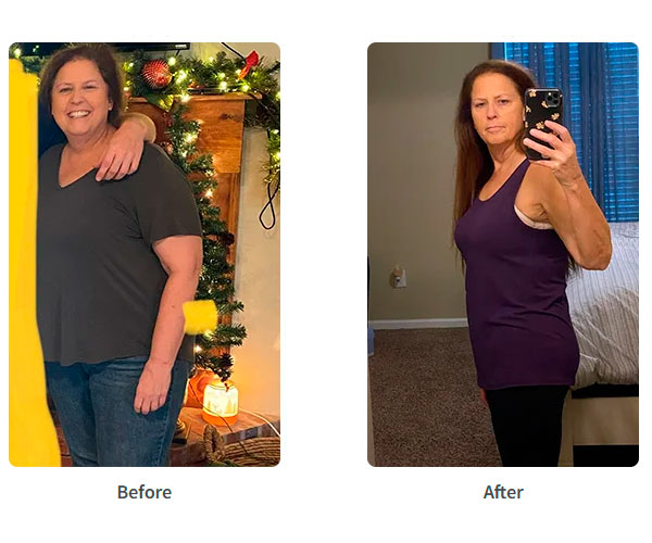 Before and after Sleeve Gastrectomy surgery - Photos by James Parrish, MD