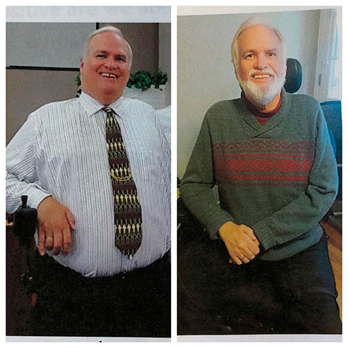 Before and after Gastric Bypass - photo by Denver Center for Weight Loss and Bariatric Surgery