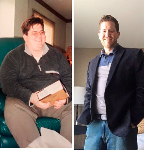Before and after Gastric Bypass - photo by Denver Center for Weight Loss and Bariatric Surgery