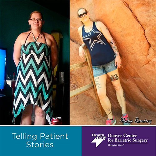Before and after Gastric Bypass - photo by Denver Center for Weight Loss and Bariatric Surgery