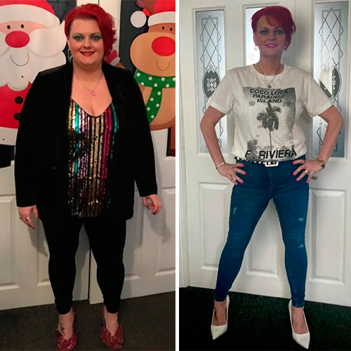 Before and after Gastric Bypass - photos by Dr Zaher Toumi