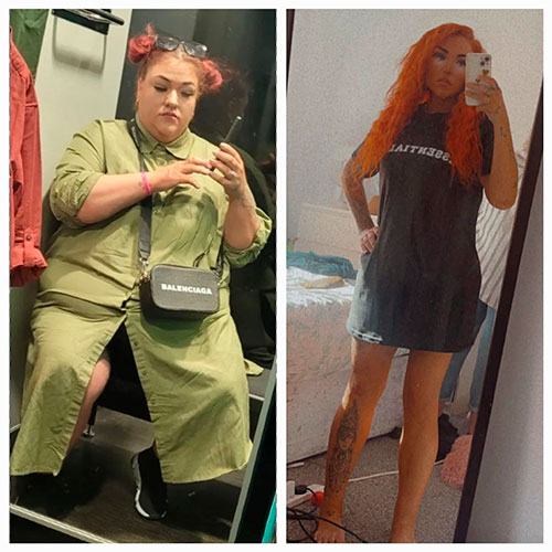 Before and after Gastric Bypass - photos by Dr Zaher Toumi