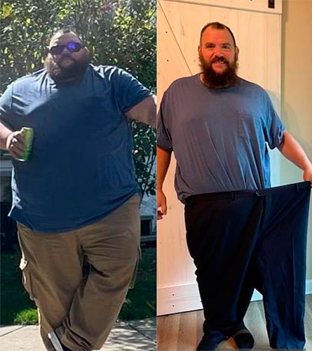Before and after Gastric Bypass - Photos by Michigan Bariatric Surgery