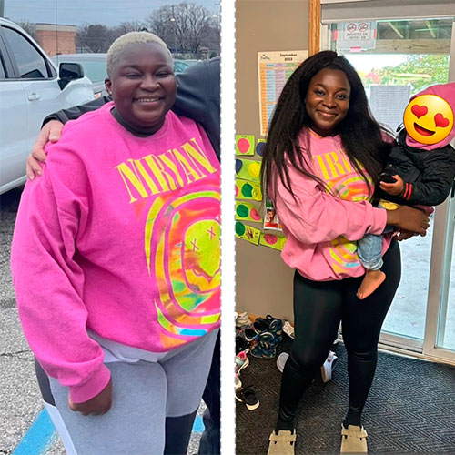 Before and after Gastric Bypass - Photos by Michigan Bariatric Surgery