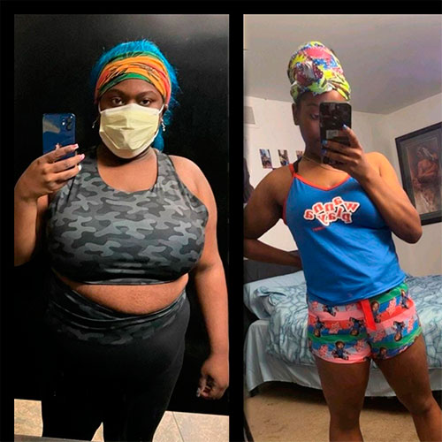 Before and after Gastric Bypass - Photos by Michigan Bariatric Surgery