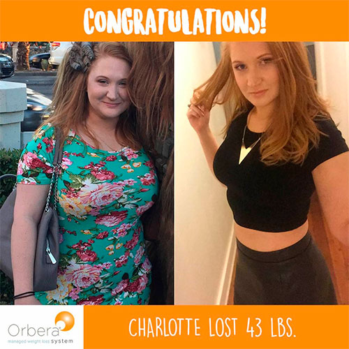 Before and after Orbera gastric balloon - photos by The Sleeve Center