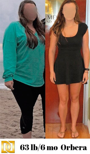Before and after Orbera gastric balloon - photos by The Weight Loss Surgery Center Of Los Angeles