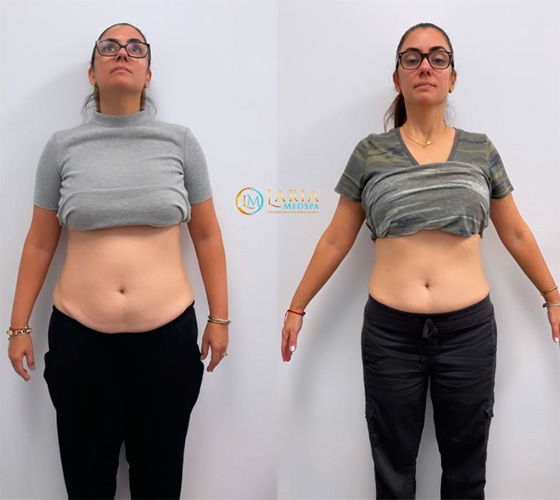 Before and after Ozempic - photos by LARIA MedSpa