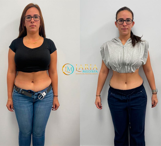 Before and after Ozempic - photos by LARIA MedSpa