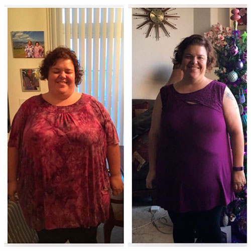 Before and after Roux-en-Y Gastric Bypass - photo by Denver Center for Weight Loss and Bariatric Surgery