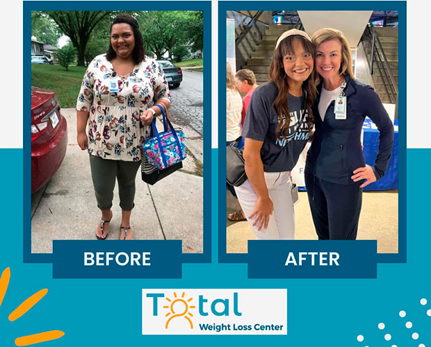 Duodenal Switch before and after - photos by Total Weight Loss Center