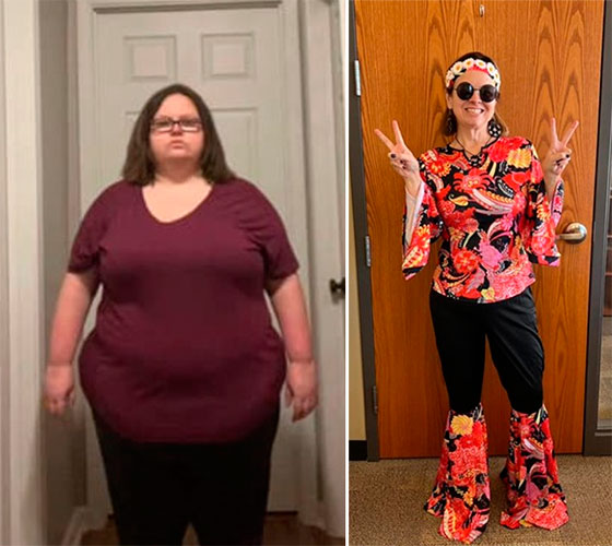 Duodenal Switch before and after - photos by Total Weight Loss Center