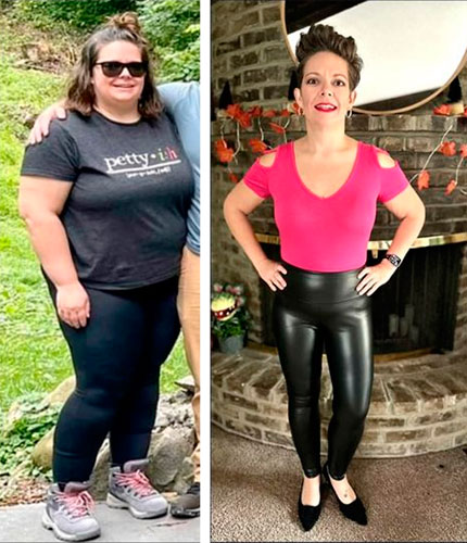 Duodenal Switch before and after - photos by Total Weight Loss Center