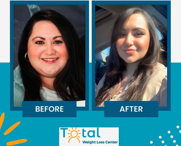 Duodenal Switch before and after - photos by Total Weight Loss Center