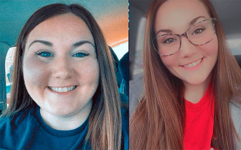 Gastric Bypass before and after - photos by Total Weight Loss Center
