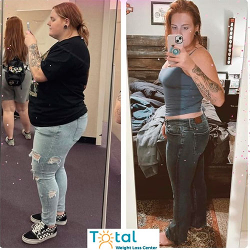 Gastric Bypass before and after - photos by Total Weight Loss Center