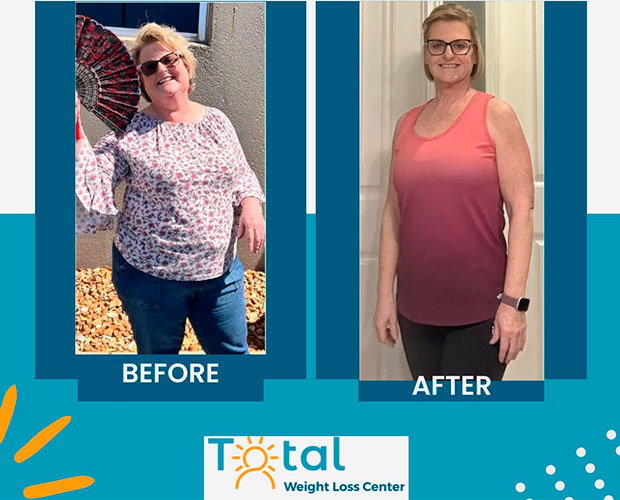Gastric Bypass before and after - photos by Total Weight Loss Center