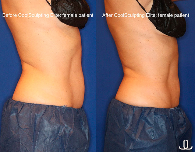 CoolSculpting before and after - photos by Jennifer Levine, MD