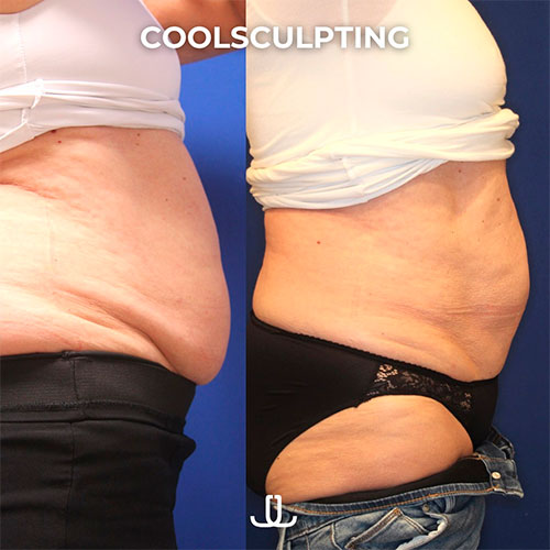 CoolSculpting before and after - photos by Jennifer Levine, MD