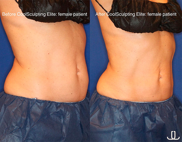 CoolSculpting before and after - photos by Jennifer Levine, MD