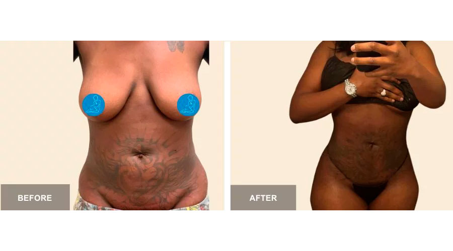 Liposuction 360 before and after - photos by South Florida Center for Cosmetic Surgery