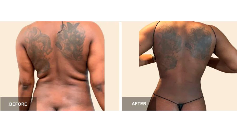 Liposuction 360 before and after - photos by South Florida Center for Cosmetic Surgery