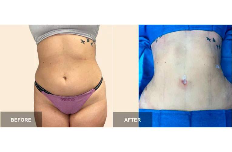 Liposuction 360 before and after - photos by South Florida Center for Cosmetic Surgery