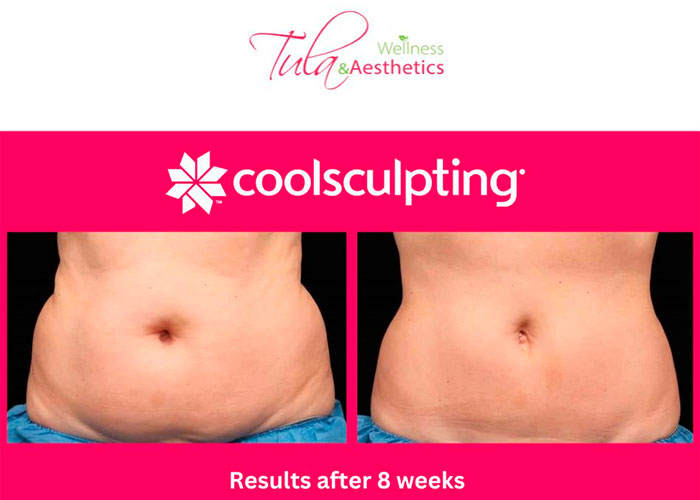 CoolSculpting before and after - photos by Tula Wellness & Aesthetics