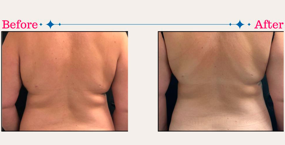 CoolSculpting before and after - photos by Tula Wellness & Aesthetics
