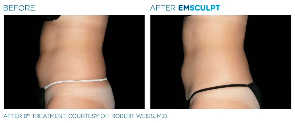 Emsculpt NEO before and after - photos by Nulevel Wellness Medspa