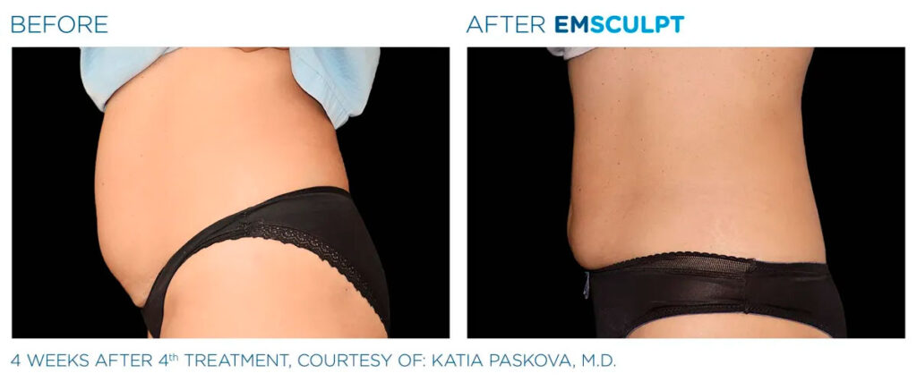Emsculpt NEO before and after - photos by Nulevel Wellness Medspa