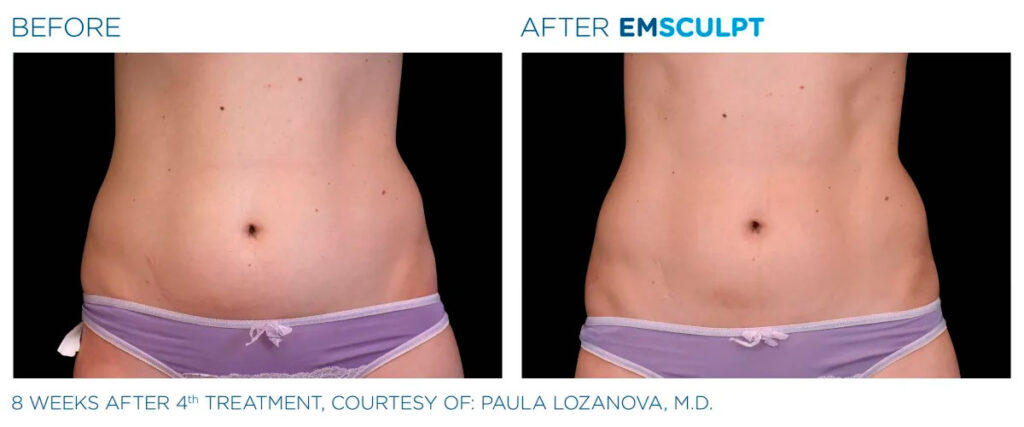 Emsculpt NEO before and after - photos by Nulevel Wellness Medspa