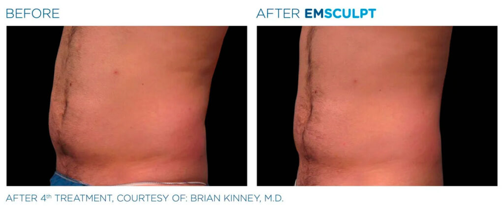 Emsculpt NEO before and after - photos by Nulevel Wellness Medspa