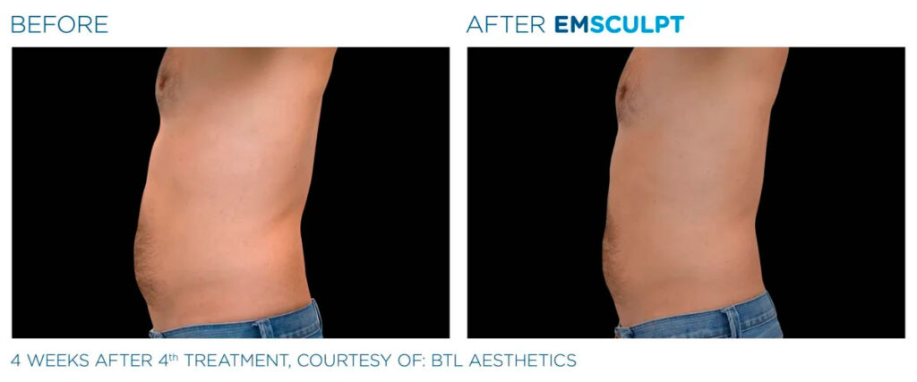 Emsculpt NEO before and after - photos by Nulevel Wellness Medspa