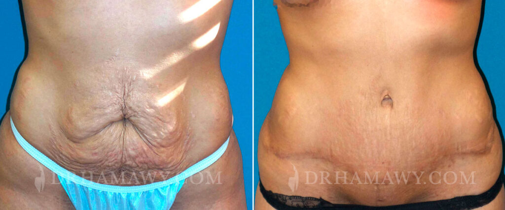 Tummy tuck before and after - photos by Princeton Plastic Surgeons