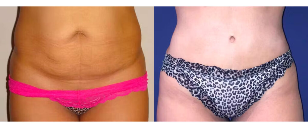 Abdominoplasty and lipo 360 before and after - photos by Alizadeh Cosmoplastic Surgery