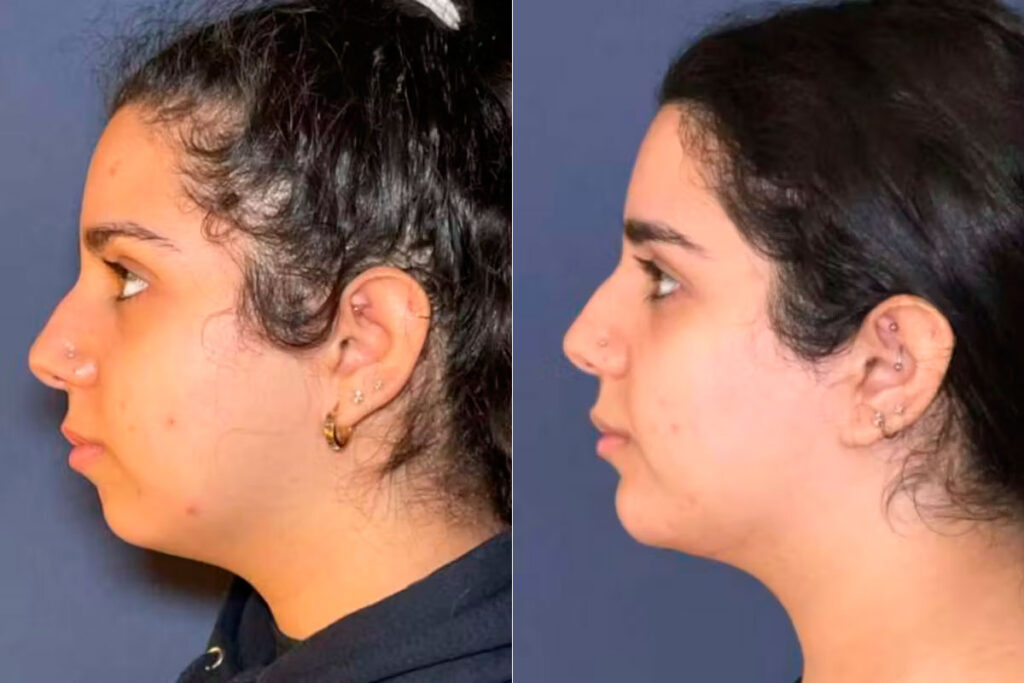Kybella before and after - photos by Alizadeh Cosmoplastic Surgery