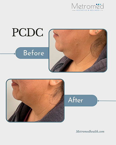 PCDC injections before and after - photos by MetroMed Health