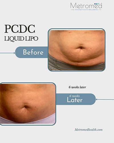 PCDC injections before and after - photos by MetroMed Health