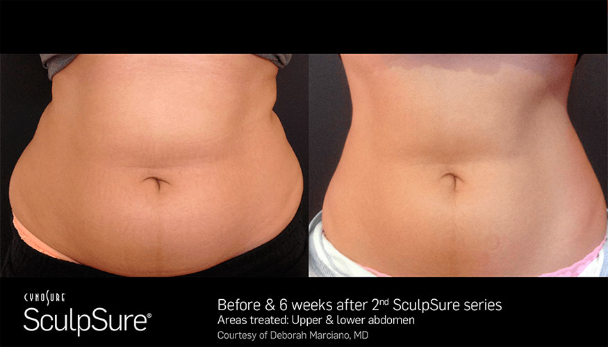SculpSure before and after - photos by Ajeless Health and Medical Spa