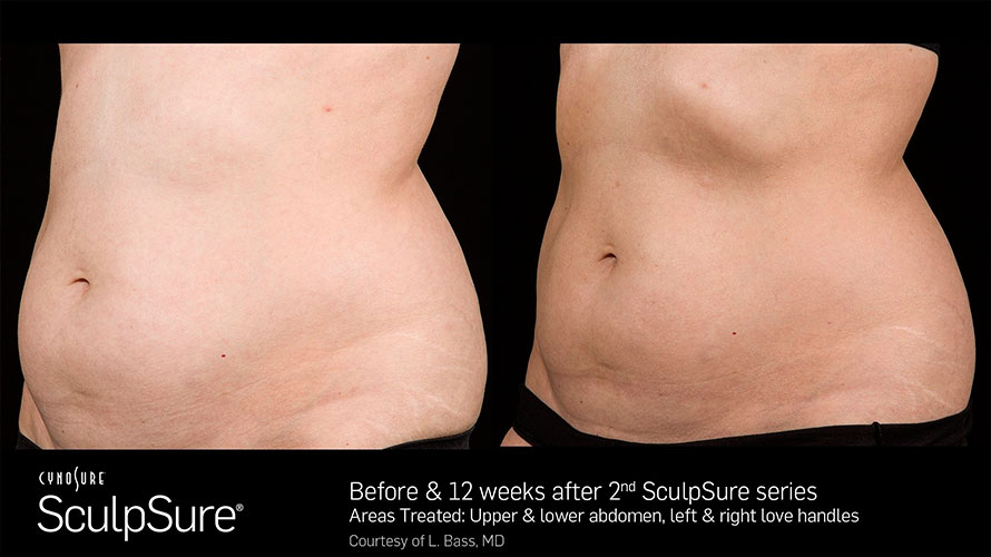 SculpSure before and after - photos by Ajeless Health and Medical Spa