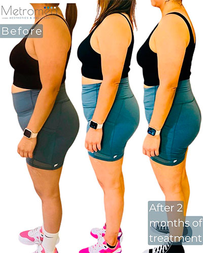 Semaglutide before and after - photos by MetroMed Health