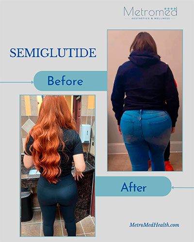 Semaglutide before and after - photos by MetroMed Health