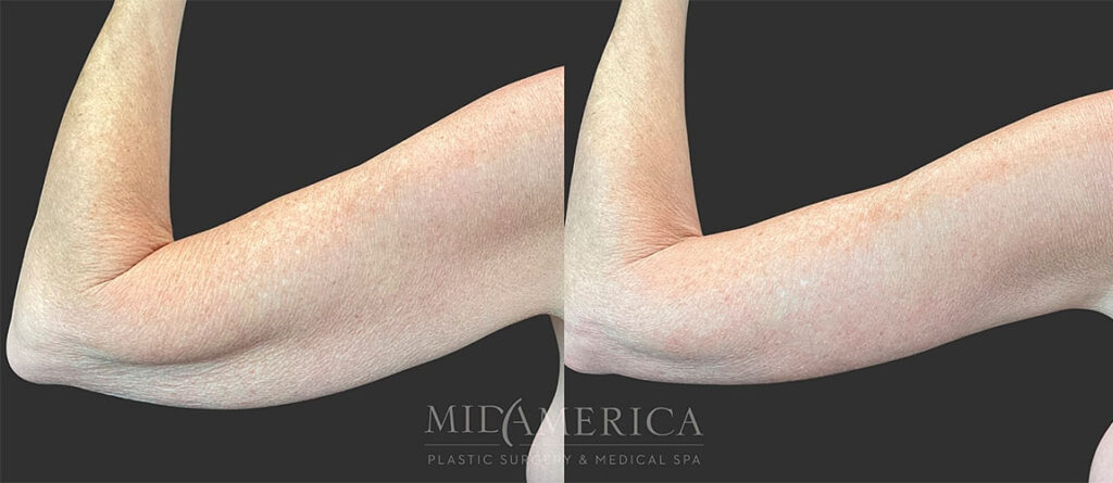 Arm lift before and after - photos by MidAmerica Plastic Surgery & Medical Spa