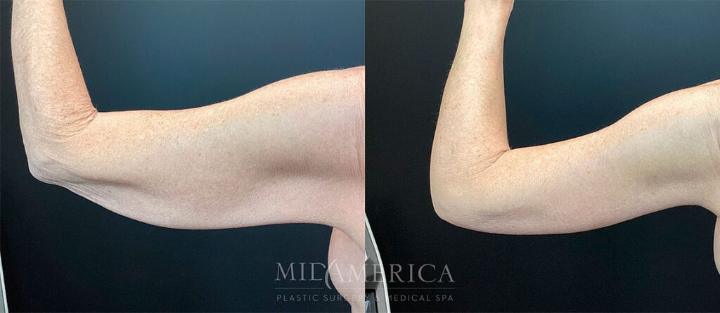 Arm lift before and after - photos by MidAmerica Plastic Surgery & Medical Spa