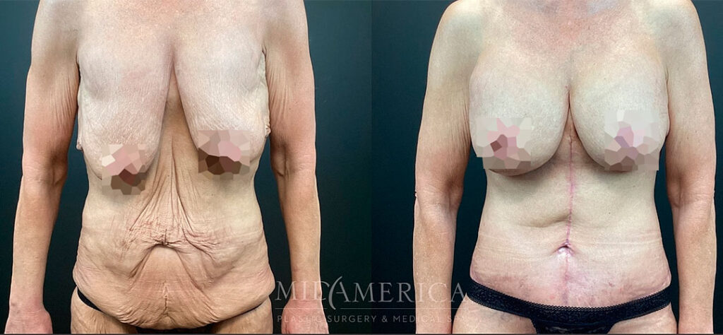 Mommy Makeover before and after - photos by MidAmerica Plastic Surgery & Medical Spa