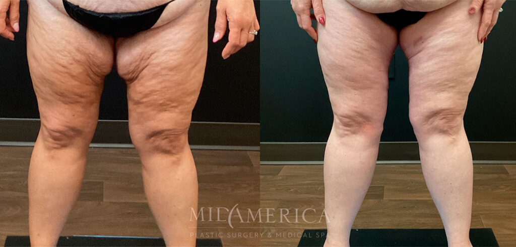 Thigh lift before and after - photos by MidAmerica Plastic Surgery & Medical Spa