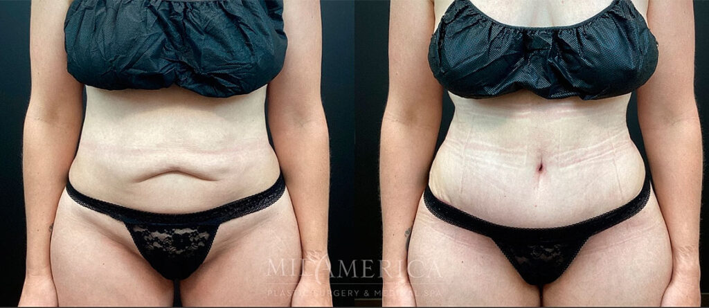 Tummy tuck before and after - photos by MidAmerica Plastic Surgery & Medical Spa